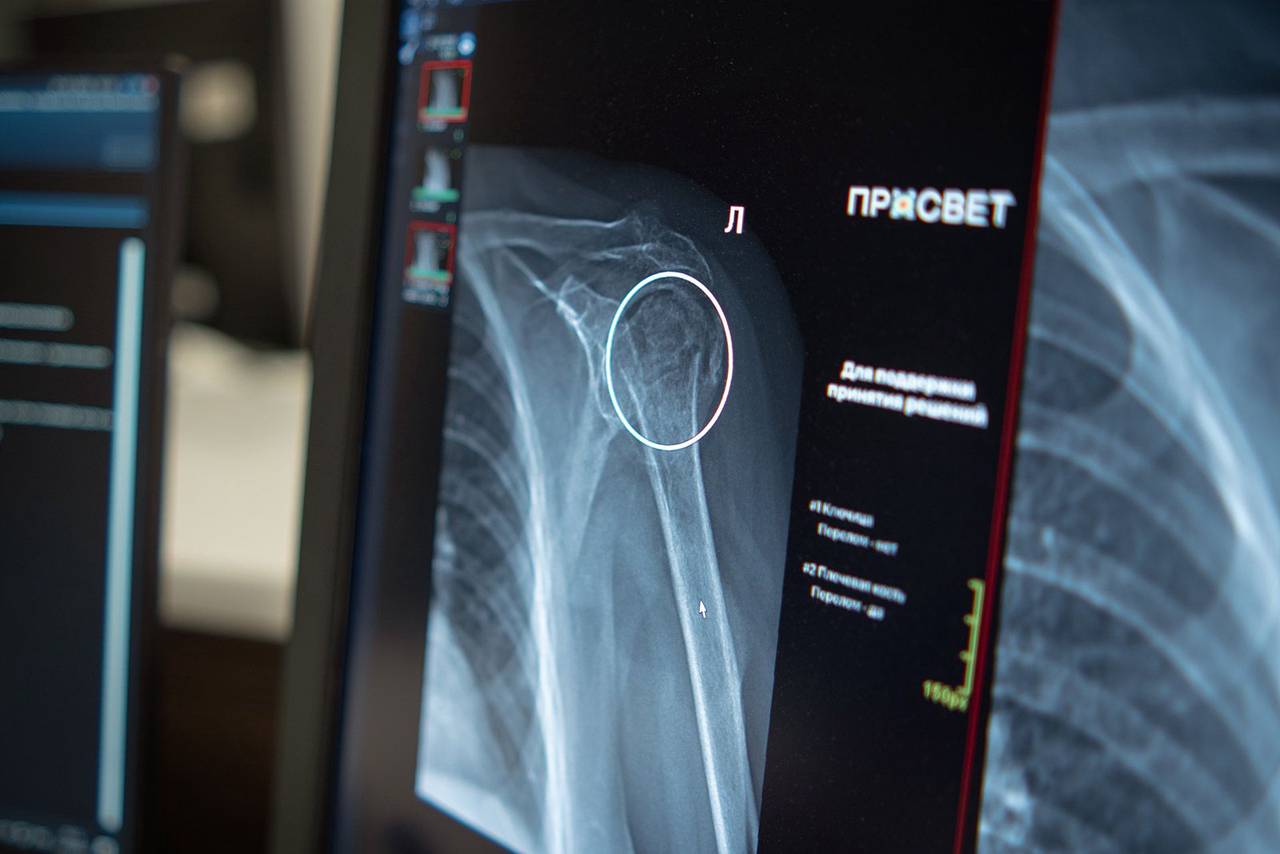 ИИ-сервис для диагностики переломов плеча появился в Москве. Фото: сайт мэра Москвы